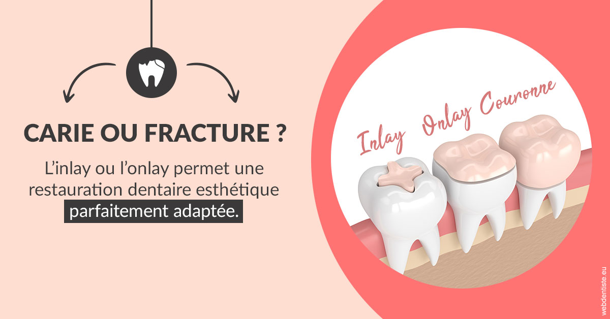 https://dr-strimon-frederic.chirurgiens-dentistes.fr/T2 2023 - Carie ou fracture 2