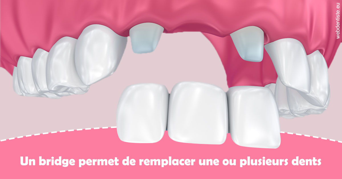 https://dr-strimon-frederic.chirurgiens-dentistes.fr/Bridge remplacer dents 2