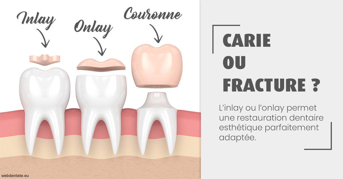 https://dr-strimon-frederic.chirurgiens-dentistes.fr/T2 2023 - Carie ou fracture 1