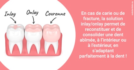 https://dr-strimon-frederic.chirurgiens-dentistes.fr/L'INLAY ou l'ONLAY 2