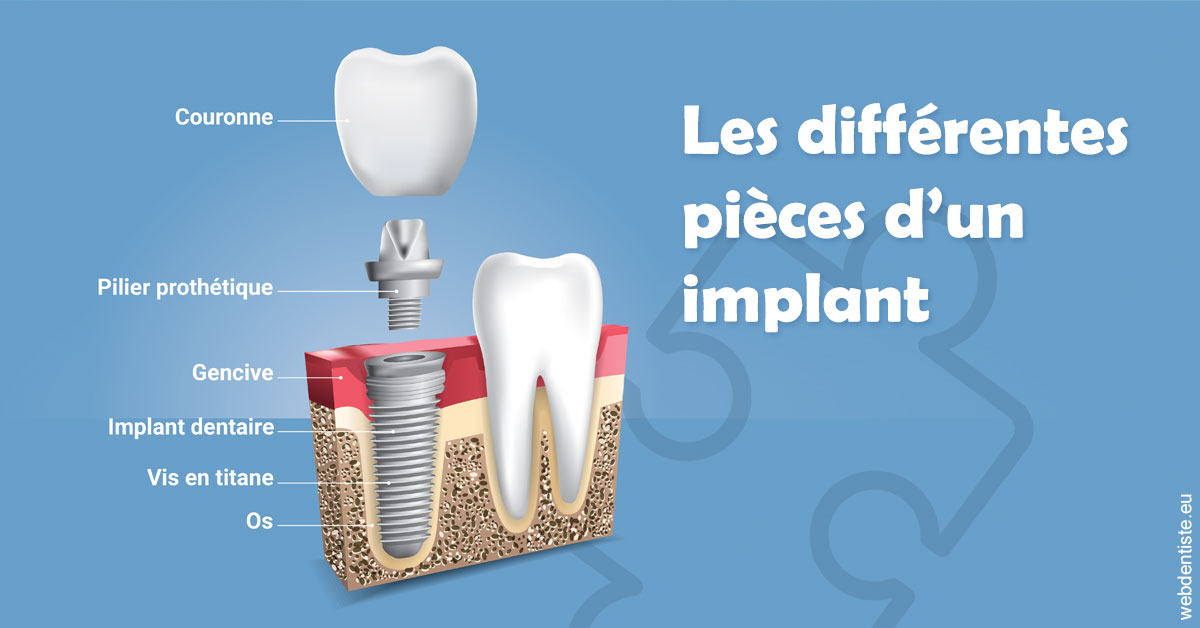 https://dr-strimon-frederic.chirurgiens-dentistes.fr/Les différentes pièces d’un implant 1