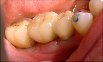 Remplacement d’un groupe de dents par des céramiques sur implants
