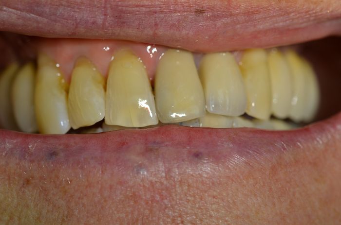 Machoire après remplacement par des dents fixées sur des implants