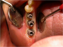 Remplacement d’un groupe de dents par des céramiques sur implants