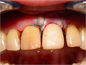 Mise en charge immédiate de la dent provisoire sur l’implant