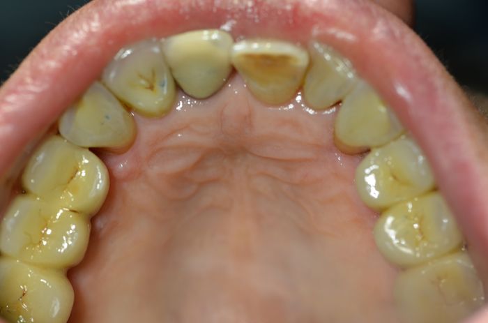 Machoire après remplacement par des dents fixées sur des implants